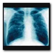 lung x-ray