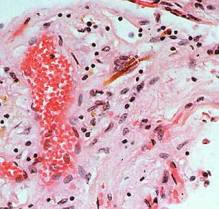image of asbestos in lungs.