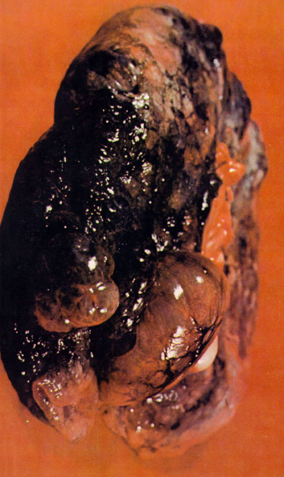 Image of lung with Emphysema.