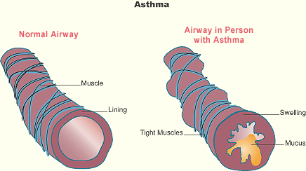 asthma-airway.gif