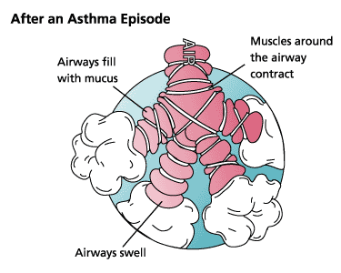 asthma_after.gif