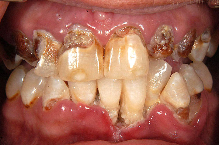 picture-of-meth-teeth.jpg