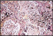 Picture of Asbestosis in lung tissue also known as Asbestosis Lung