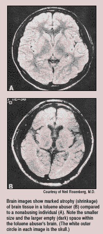 toluenebraindamage.gif