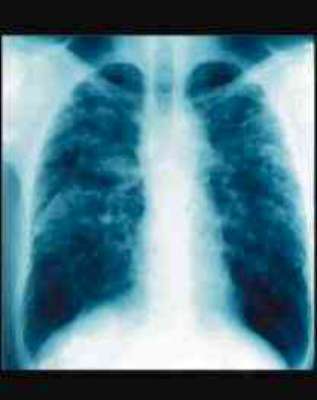 Lung x-ray Asbestosis