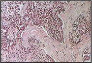 Microscopic view of mesothelioma cells which usually form in the Mesothelium, Pericardium, or Peritonium membranes